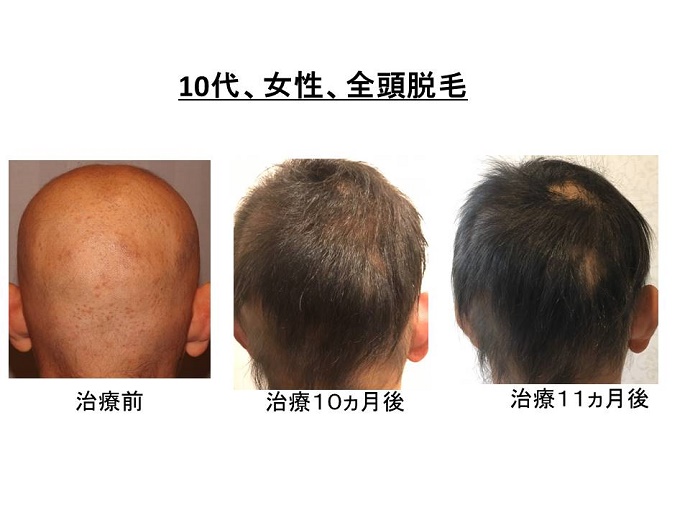 円形脱毛症　病院""
